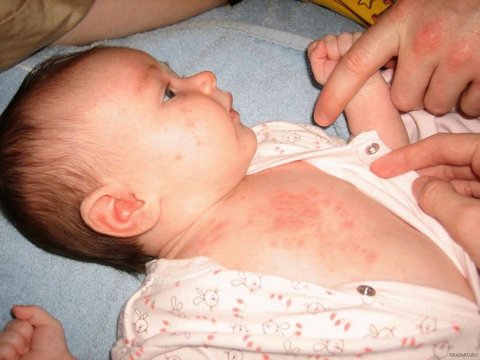 Раздражение кожи у новорожденных детей: причины, профилактика и лечение.